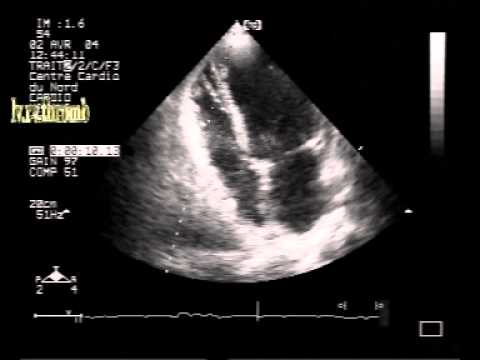 Dissecting Hematoma Of The Interventricular Septum With Biventricular Apical Small Thrombi