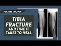 Ask The Doctor Tibia Fracture And Time It Takes To Heal