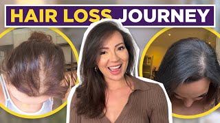 HAIR LOSS TREATMENT FOR WOMEN| MY FEMALE HAIR LOSS JOURNEY + TIPS ON HAIR LOSS