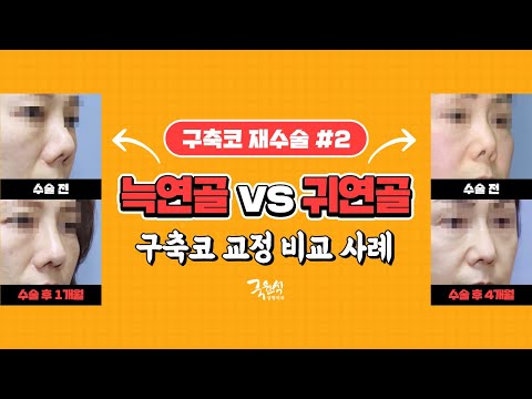 #구축코재수술 실제 사례와 함께 보는 늑연골 or 귀연골! 결정을 돕기 위한 설명!