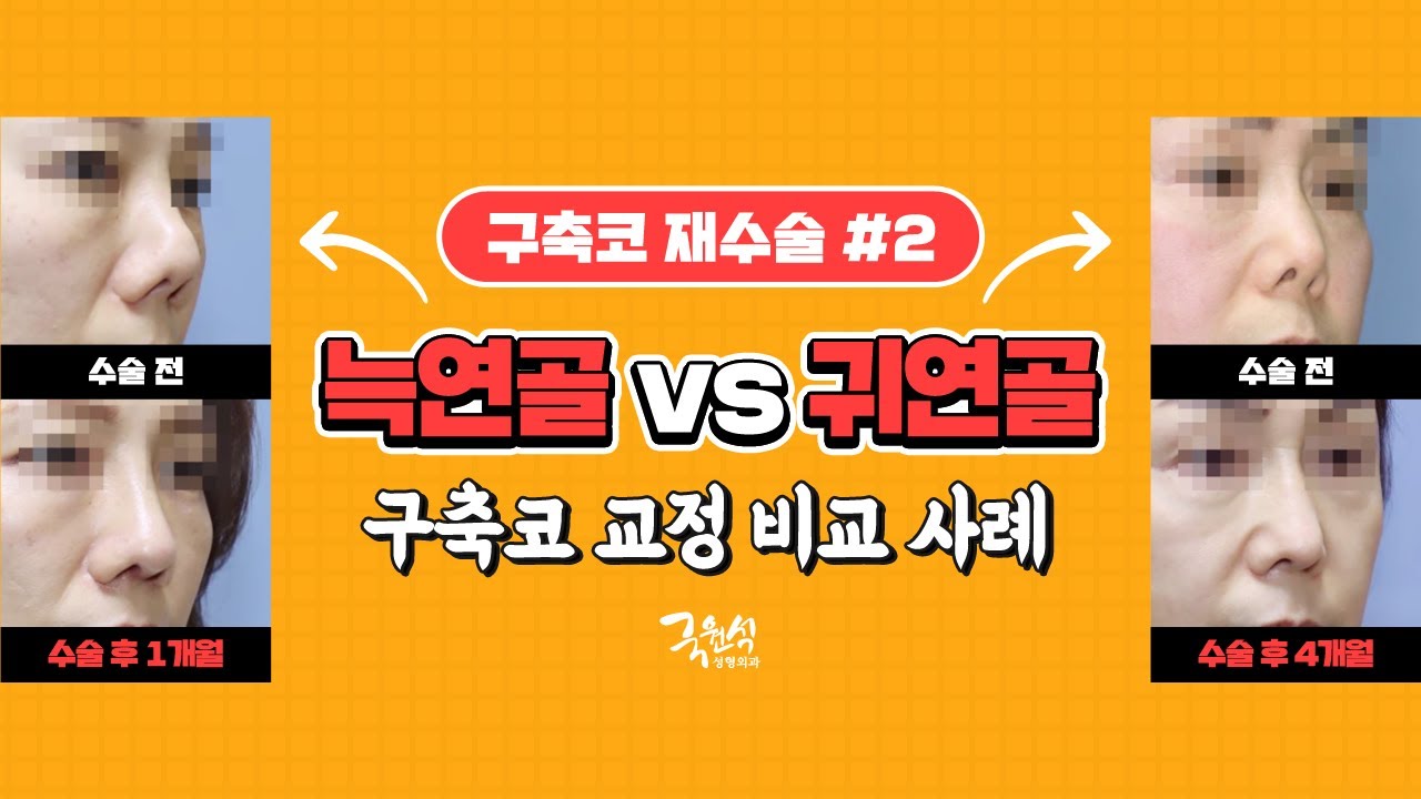#구축코재수술 실제 사례와 함께 보는 늑연골 or 귀연골! 결정을 돕기 위한 설명!