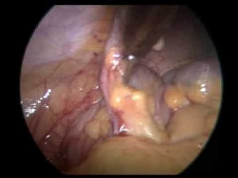 Lap appendicectomy