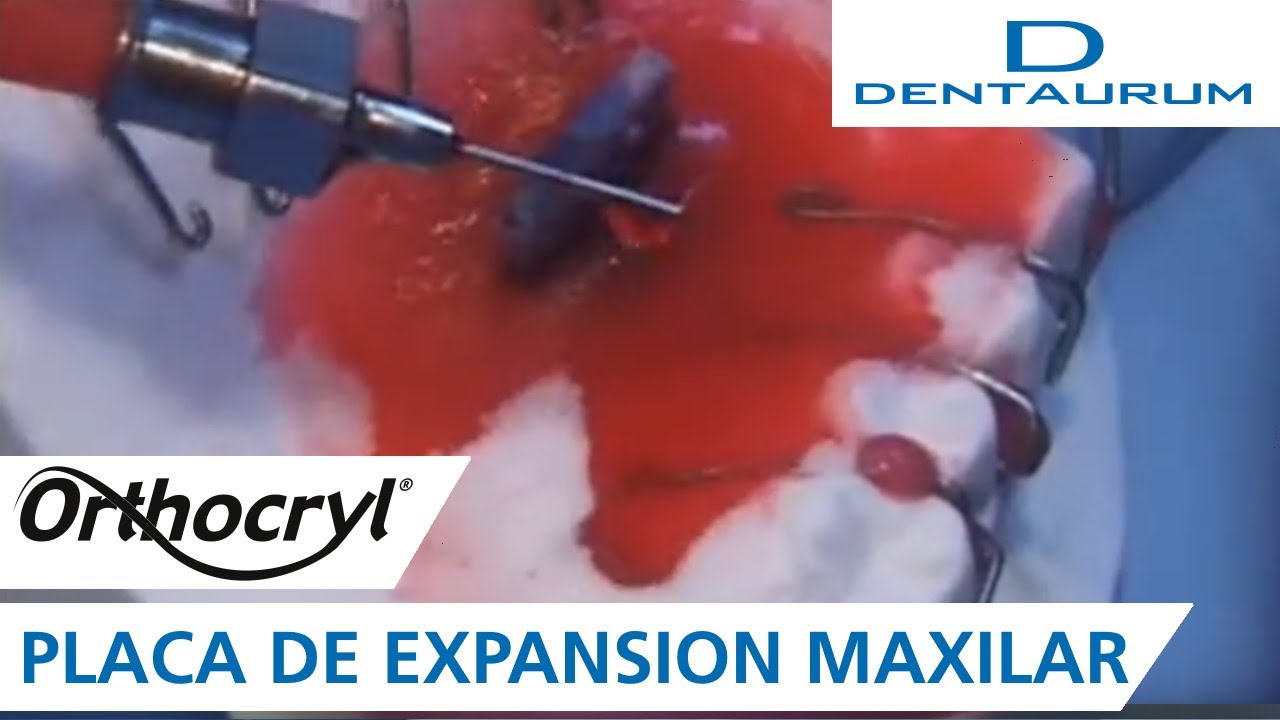 Orthocryl® - placa de expansión maxilar con la técnica de rociado (aparatos dentales)
