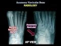 Accessory Navicular Bone - Everything You Need To Know - Dr. Nabil Ebraheim