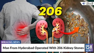 Man From Hyderabad Operated With 206 Kidney Stones