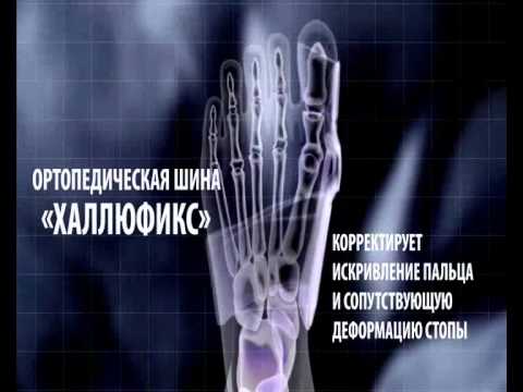 Guz na podbiciu Leczenie deformacji kości stopy