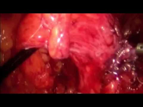 Minimally Invasive Colon Management