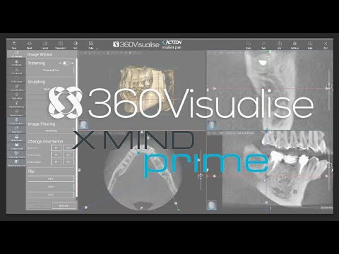 Acteon XMIND Prime General CBCT Overview of AIS 3D software