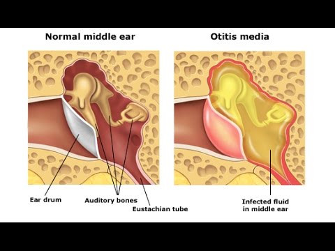 Otitis Media - YouTube