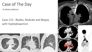 Case of the Day - 115 - 2025 10 08 - Nodules, Nodes and Biopsy with Hydrodissection
