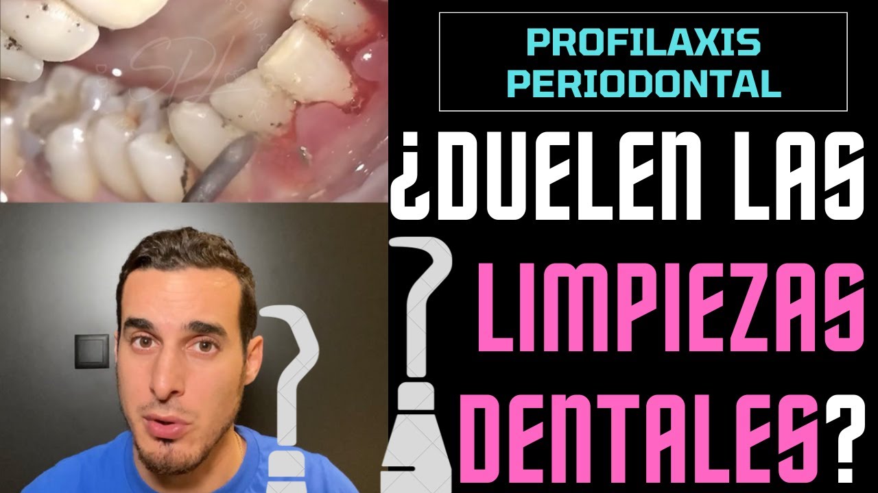 ¿DUELEN las LIMPIEZAS DENTALES o BUCALES Aquí te lo explico