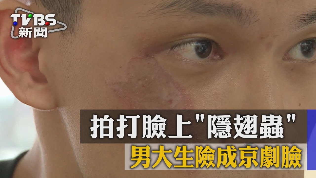 拍打臉上「隱翅蟲」　男大生險成京劇臉