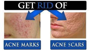 8 TIPS to get rid of ACNE SCARS & MARKS on your face