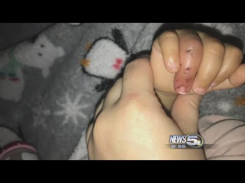 Goat Bite at State Fair Causes Rabies Scare