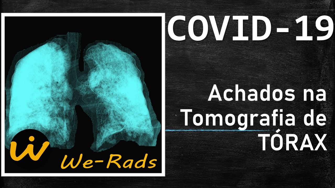 COVID-19 - Achados na Tomografia Computadorizada (TC) de Tórax do novo  coronavírus