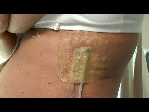 How to care for post-surgery wound drainage system and DuoDerm dressing