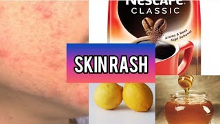 How to get rid of face rashes