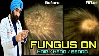 Cure FUNGAL Infection on scalp, Head, Hair, Beard (Tinea capitis) | Ringworm | Dr.Education (Eng)