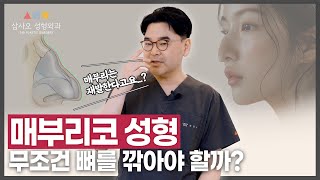 매부리코 보형물 사용, 필수일까?  매부리코 수술 전 꼭 알아야 할 핵심 포인트! _[삼사오 성형외과]