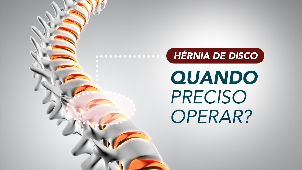 Hérnia de disco: quando preciso operar?