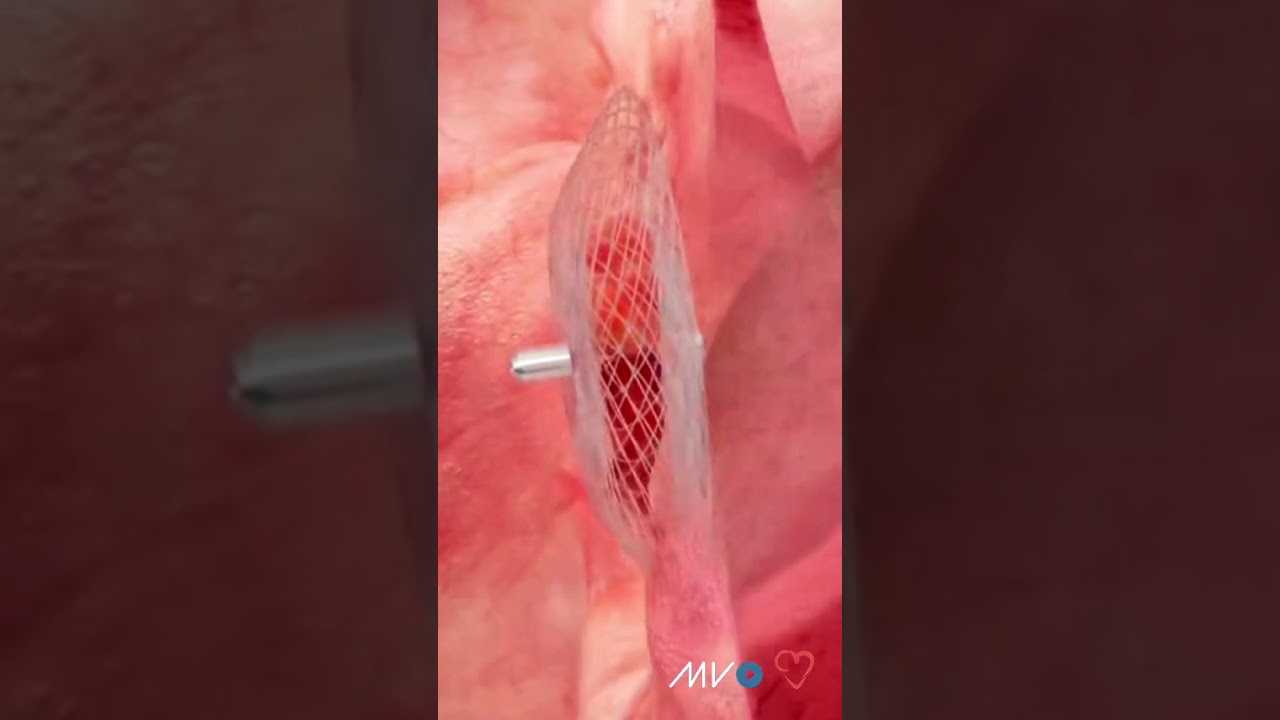 How is a PFO or 'hole in the heart' fixed?