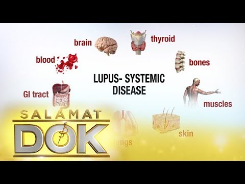 Salamat Dok: Information about lupus