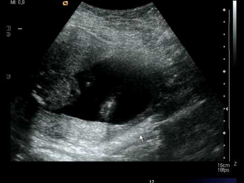 Stella "vinkar" i magen, UL vecka 19.