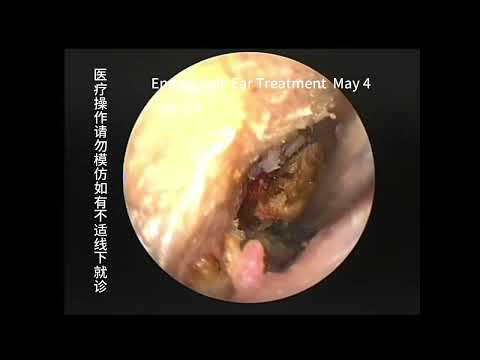 How to deal with cases of cholesteatoma misdiagnosed as cerumen