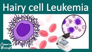 Hairy Cell Leukemia | Pathology of Hairy Cell Leukemia | Diagnosis and Treatment