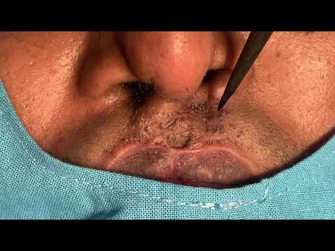 Bilateral Secondary Upper Lip Scar Revision