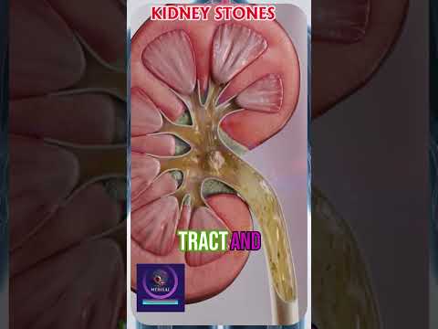 Kidney Stone Pain Explained | How Kidney Stones Form & Ways to Avoid Them