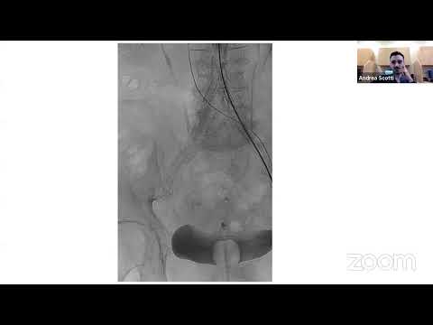 Hostile femoral access in patients undergoing TAVI, Tullio Palmerini, MD