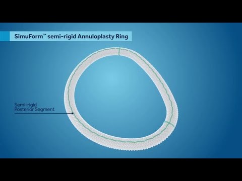 Mitral Repair with the SimuForm™ Semi-Rigid Ring and CG Future™ Band