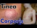 Tinea corporis infection |  Ring worm symptoms, treatment and causes