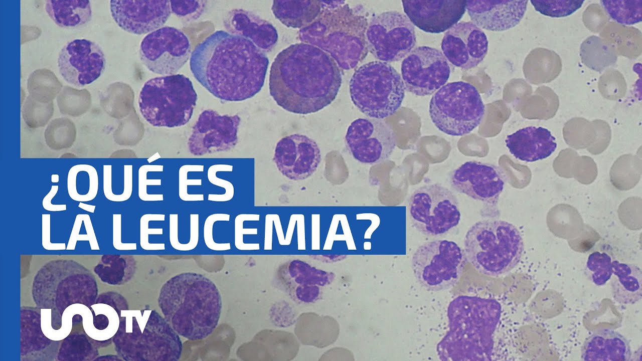 Leucemia: cómo y qué es este cáncer