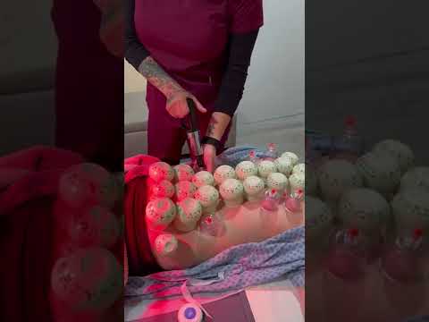 Chiropractic Adjustment +Acupuncture + Cupping Therapy! Part 2