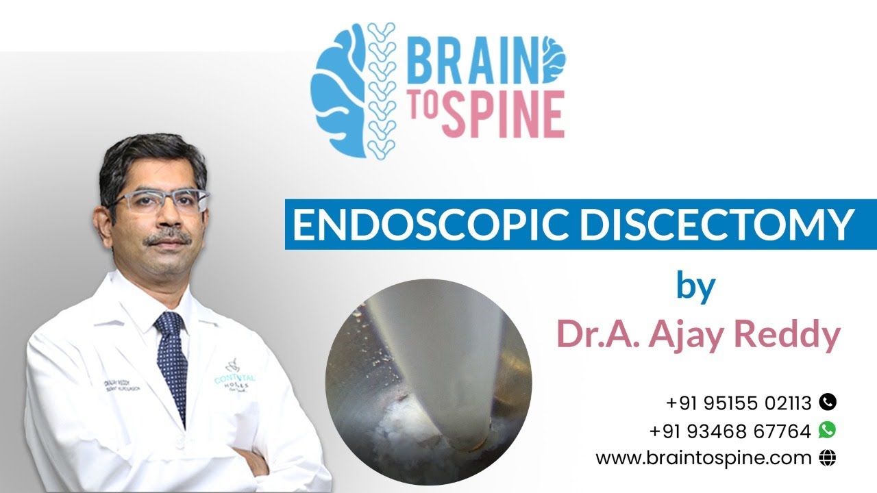 Endoscopic Disectomy by Dr A Ajay Reddy