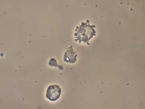 Bacteria attacking White Blood Cells