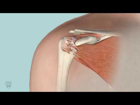 Mayo Clinic Minute: When is rotator cuff surgery right for you?
