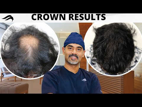 Hair Transplant In Dubai | Best Cost Results Clinic &...