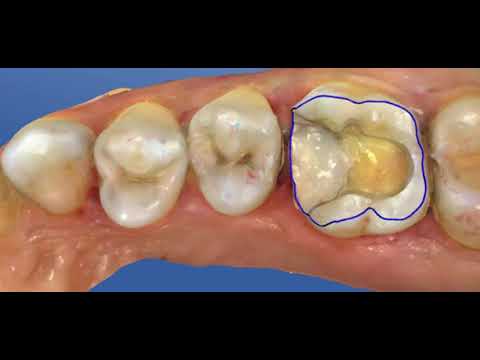 Coltene Crios, Coltene DCode on Vimeo