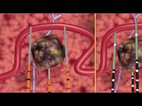 Prostatitis Schmerz nur nach links Bienen Behandlung von Prostata