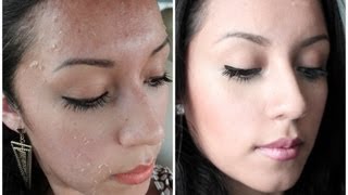 ANTES Y DESPUES TCA PEELING vs MICRODERM PMD