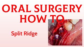 Oral Surgery How To: Split Ridge technique mandible in 2 stages