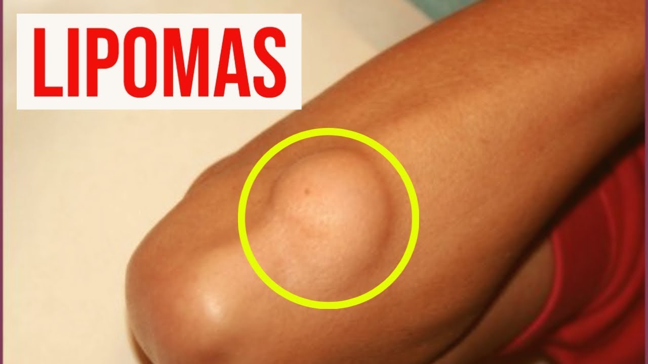 LIPOMA: síntomas, diagnóstico, tratamiento y pronóstico (bolas, bultos o tumores de grasa)