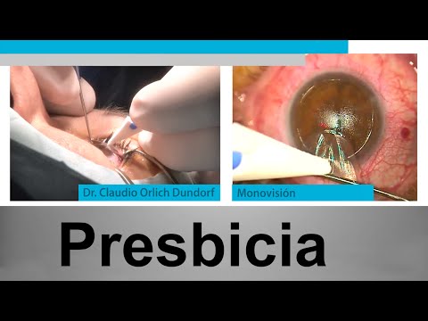 Presbyopia | Monovision Surgery | Clinic 2020