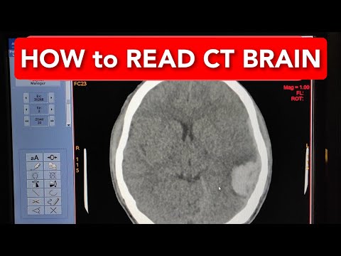 How to Read a CT Scan BRAIN.
