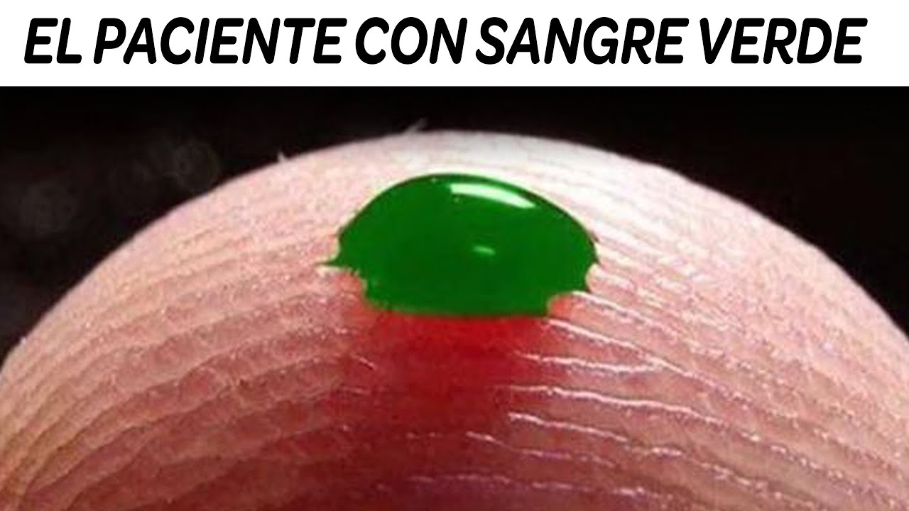 7 Enfermedades Más Extrañas y Raras que No Creerás Que son Reales.
