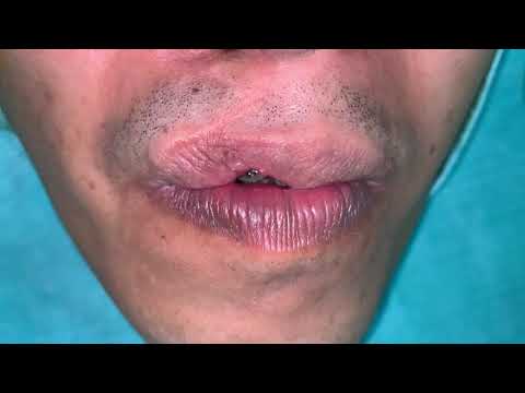 Revision Or Improvement Lip Surgery