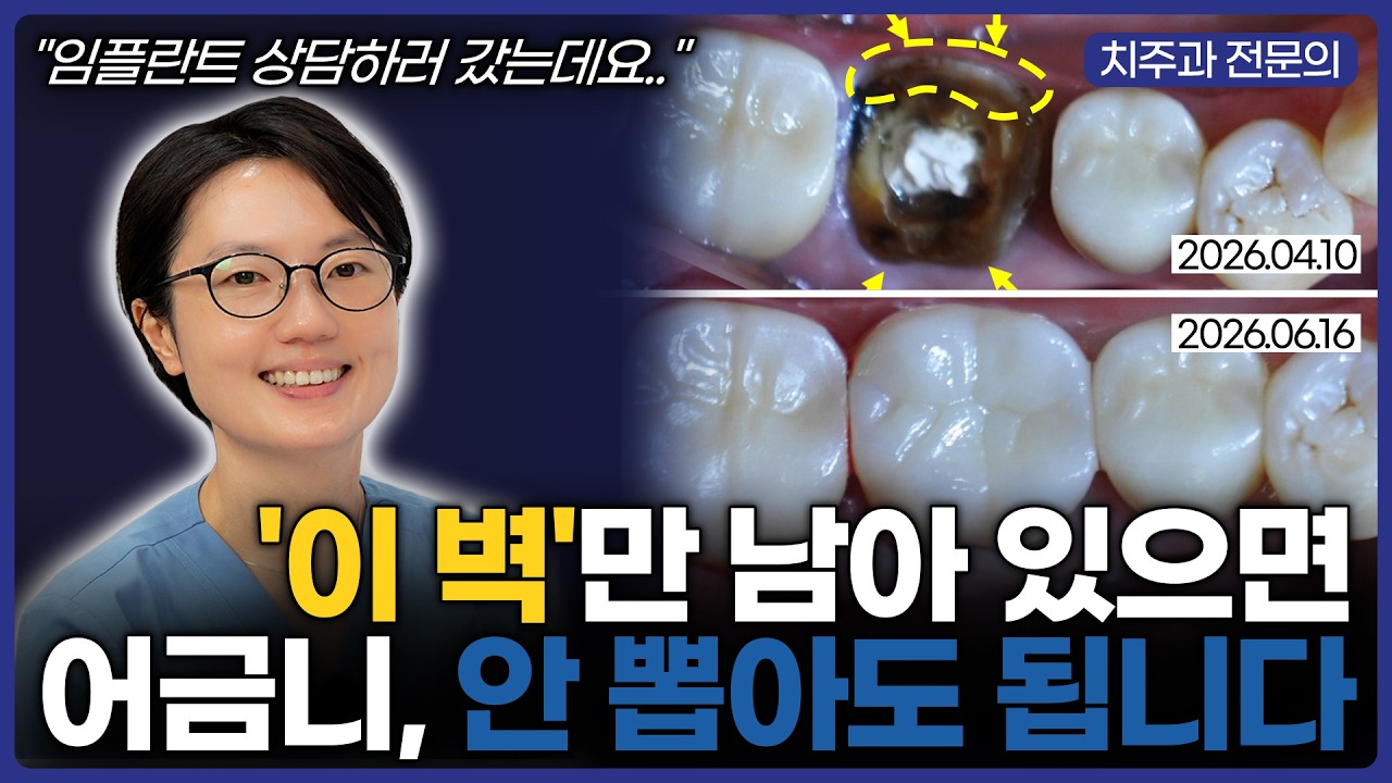 어금니 발치 권유받았다면? 신경치료로 살릴 수 있는지 가르는 요소 영상 썸네일